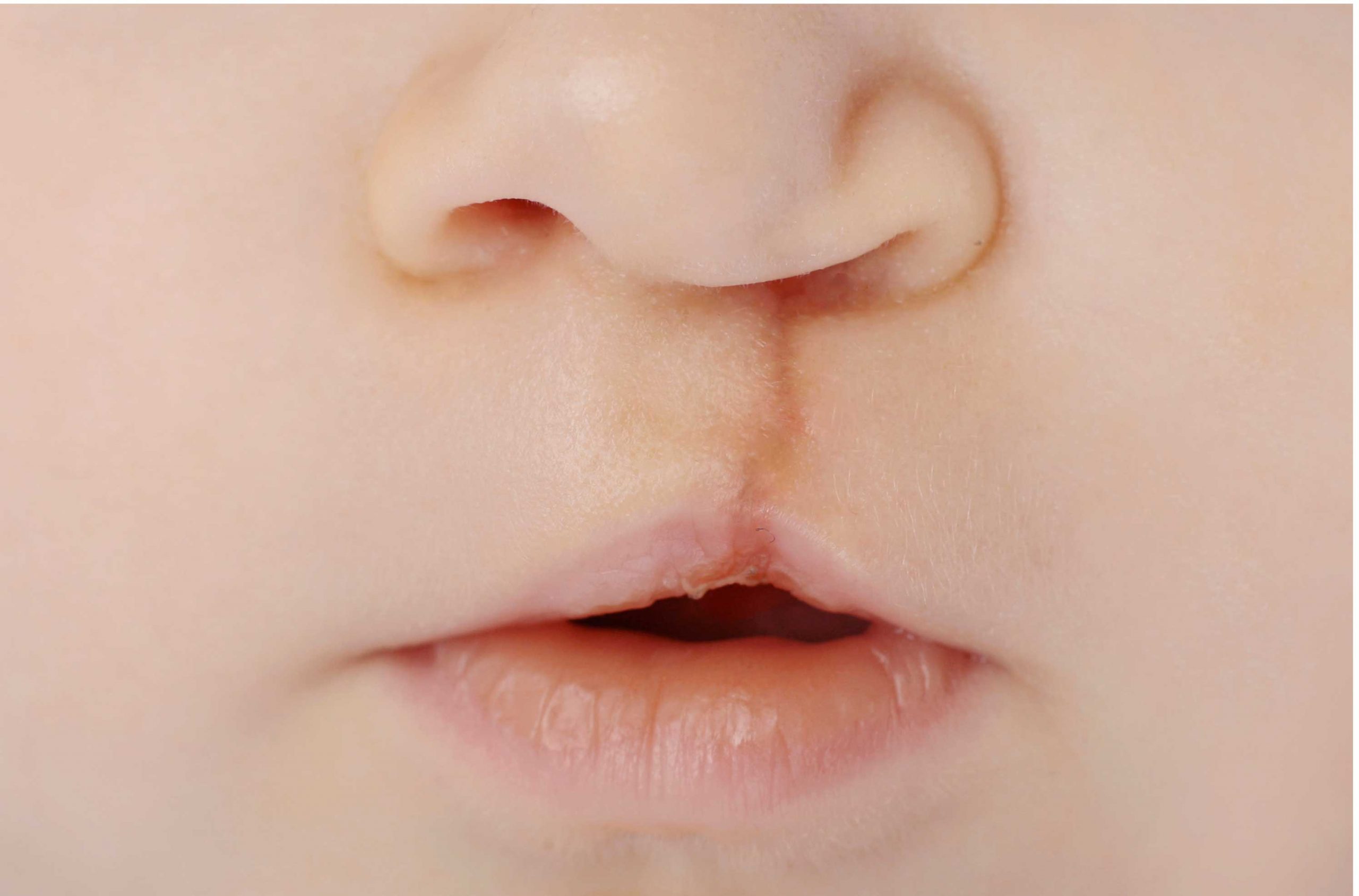 Cleft Palate Rectification Surgery in Howrah, super speciality hospital in howrah for Cleft Palate Rectification Surgery, free of cost Cleft Palate Rectification Surgery in Howrah, free Cleft Palate Rectification Surgery in kolkata, free Cleft Palate Rectification Surgery in west bengal